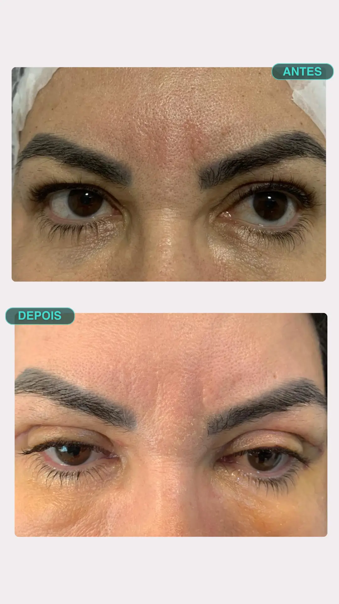 Blefaroplastia a Laser — antes e depois, paciente 1