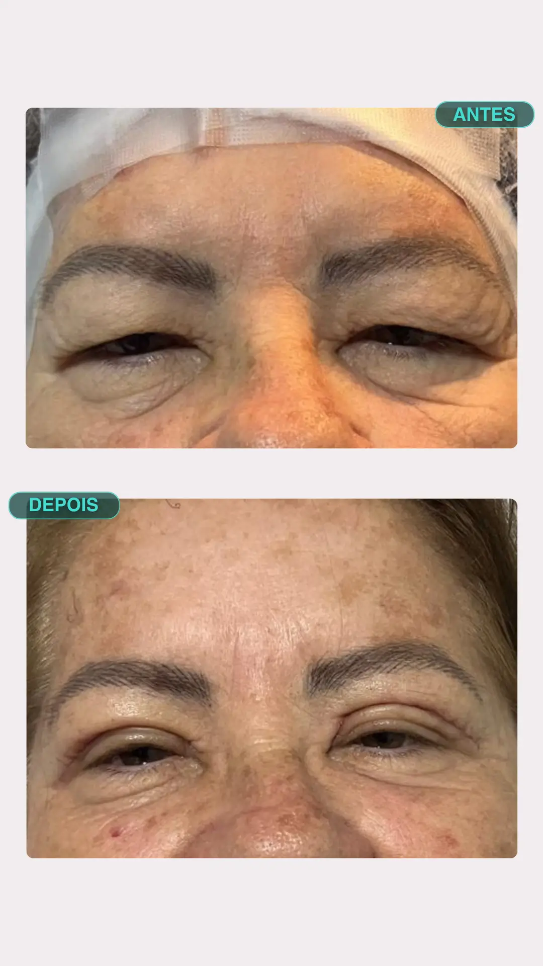 Blefaroplastia a Laser — antes e depois, paciente 3