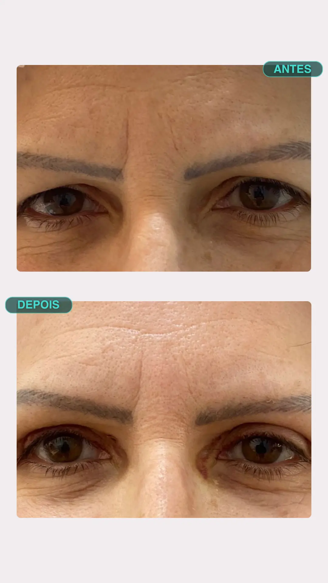 Blefaroplastia a Laser — antes e depois, paciente 4